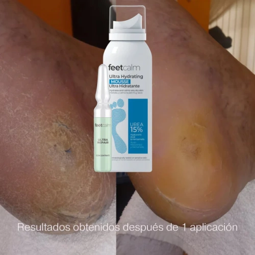 Set Profesional de Ampollas FeetCalm para Hidratación, Renovación y Reparación Intensiva, 30 ampollas x 2 ml